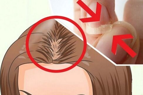 Probleme mit Haaren und Nägeln aufgrund von Parasiten.